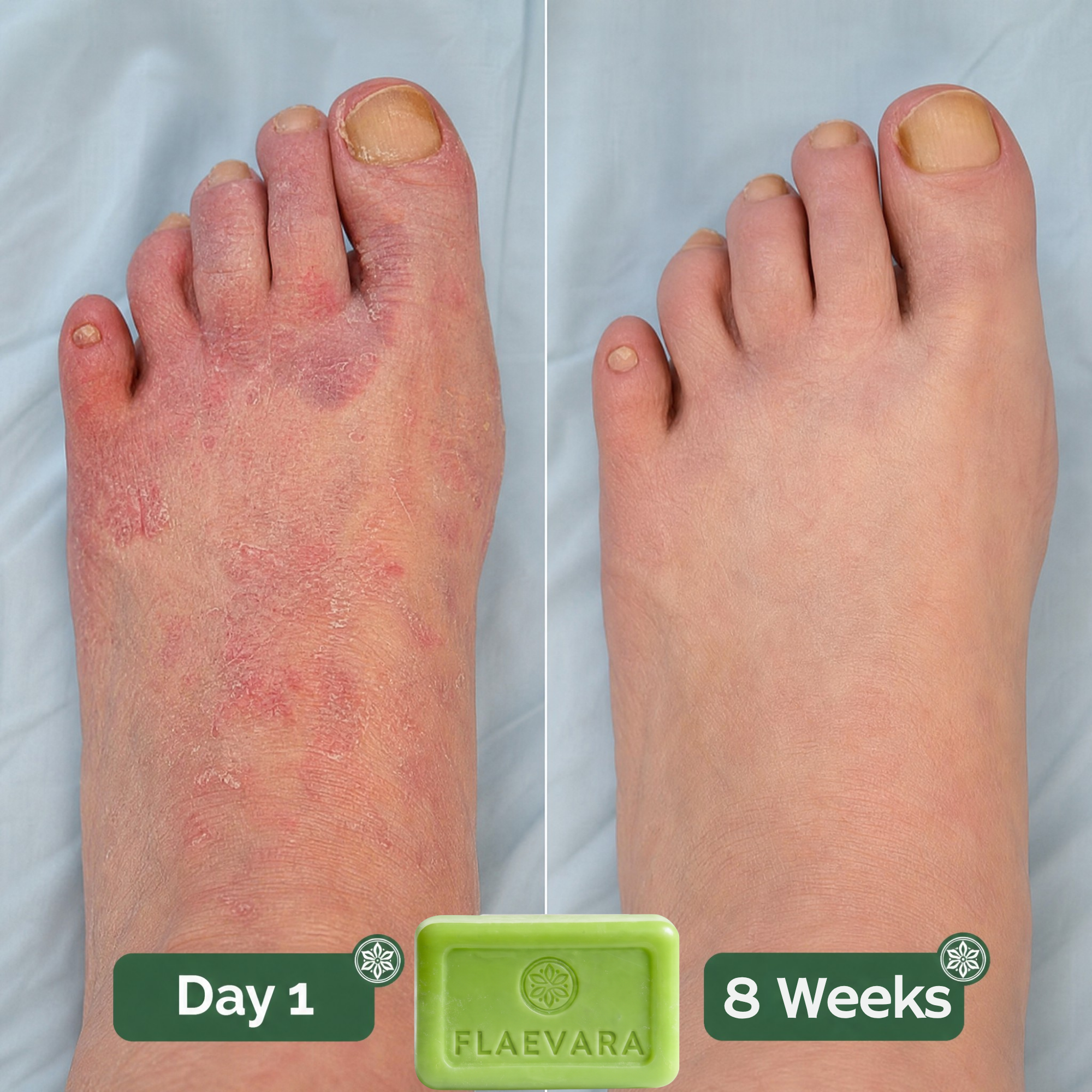 Flaevara™ Tea Tree Antifungal Soap